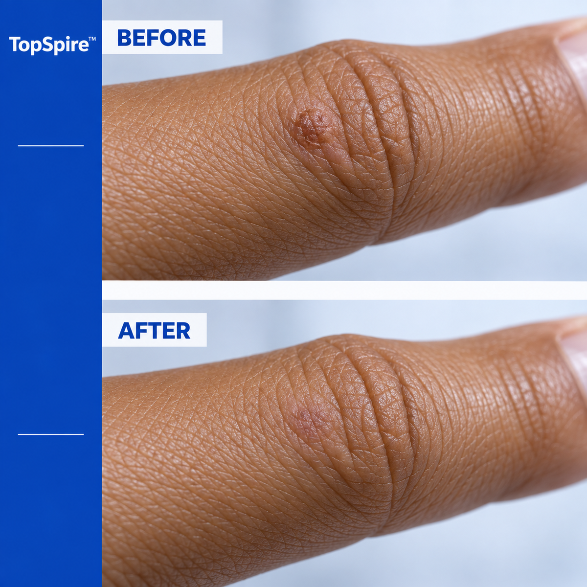 TopSpire™ Salicylic Acid Skin Repair Gel