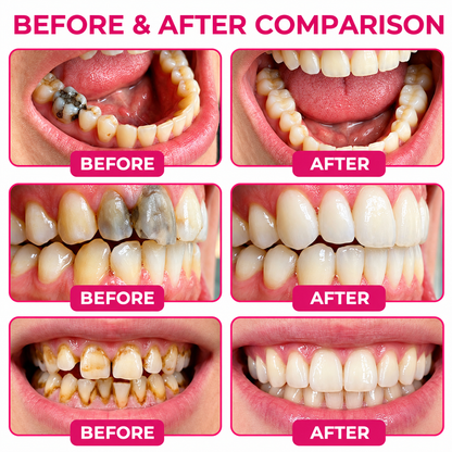 TopSpire™ DenPerm Cavity-Repair Natural Enamel Filling Gel