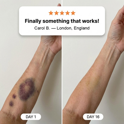 💥Over 100,000 units sold💕 - Luxgloe® cream to repair bruises and strengthen the skin